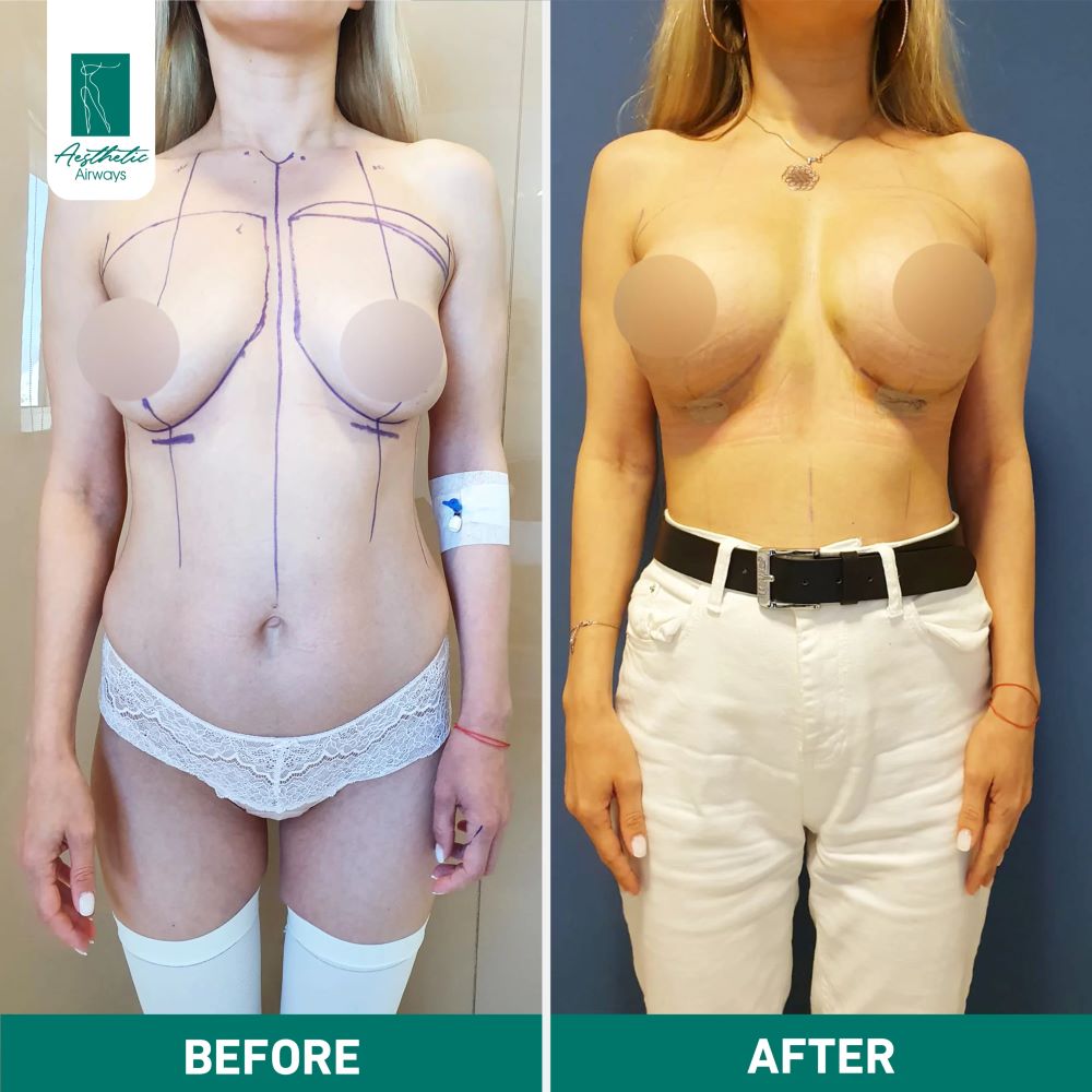 Breast Surgery