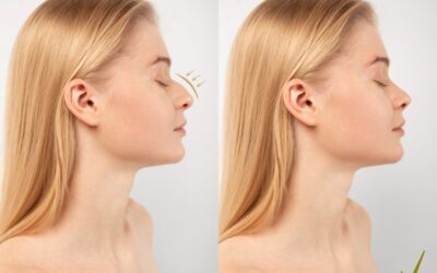 The Complete Guide to Rhinoplasty (Nose Job): What You Need to Know