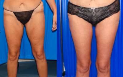 Thigh Lift Scars After 1 Year: What to Expect & How to Minimize Them
