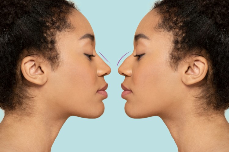 Ethnic Rhinoplasty
