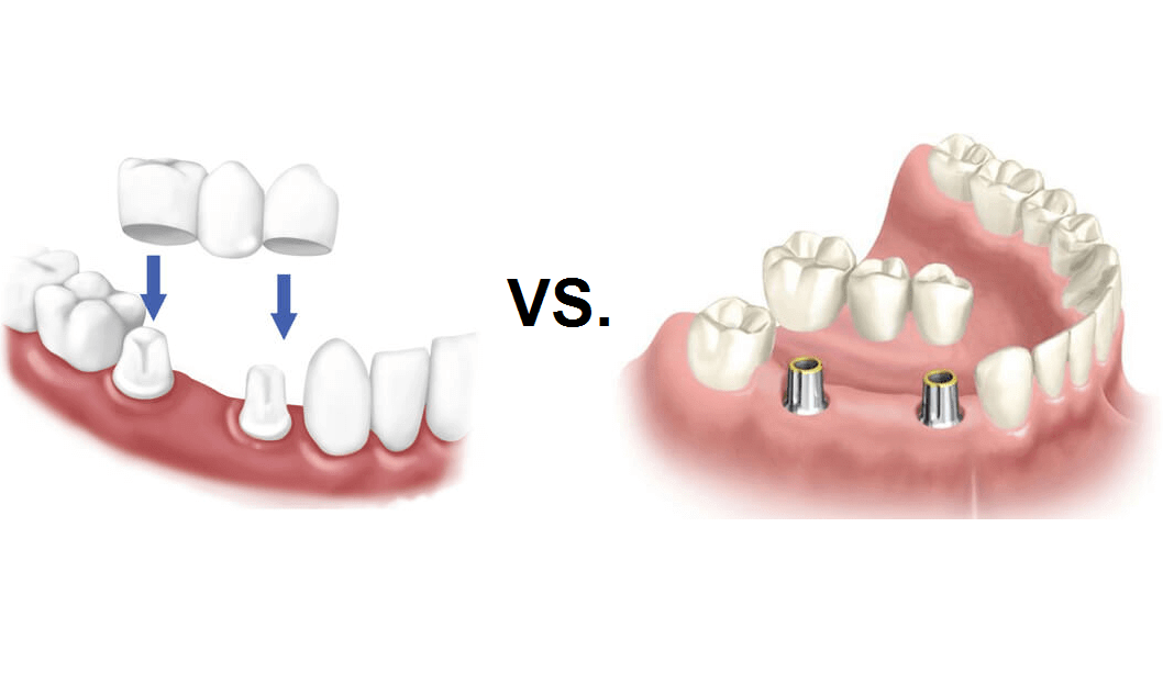 tooth implant vs dental bridge