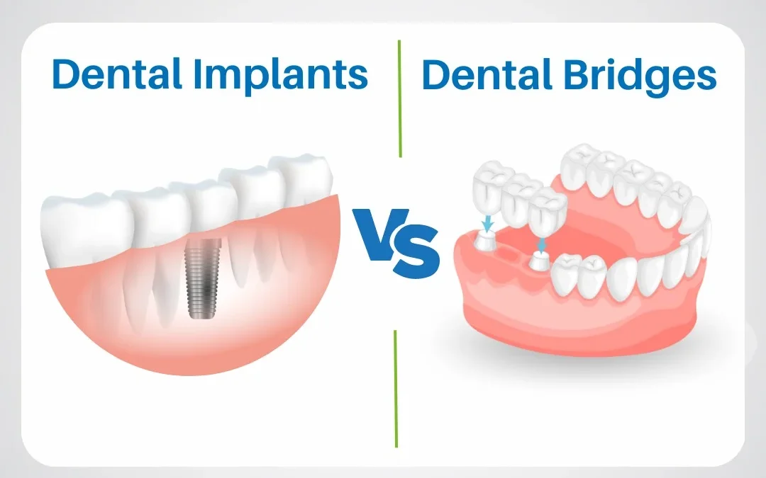 Dental Bridge vs Implant : Which Is Right for You?
