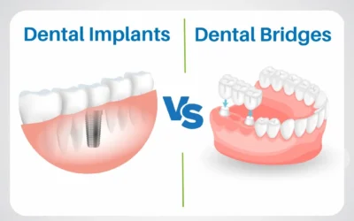 Dental Bridge vs Implant : Which Is Right for You?