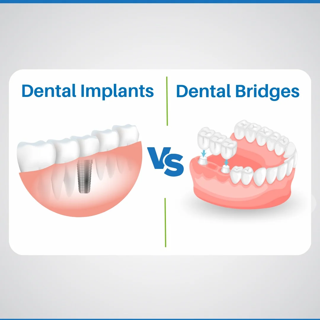 WhatsApp-Image-2023-03-15-at-12.54.48-PM dental bridge vs implant