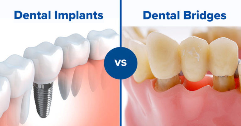Dental Bridge vs Implant Cost