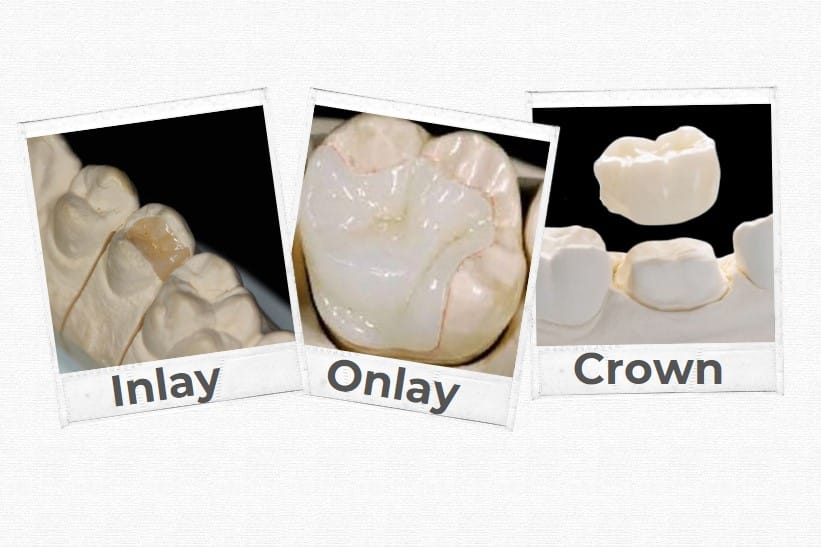 Dental Inlays, Onlays, vs. Crown