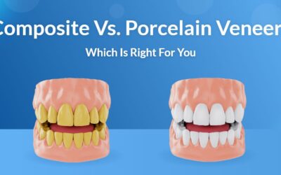 Composite vs Porcelain Veneers: Your Ultimate Guide to a Perfect Smile