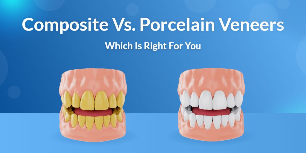Composite vs Porcelain Veneers