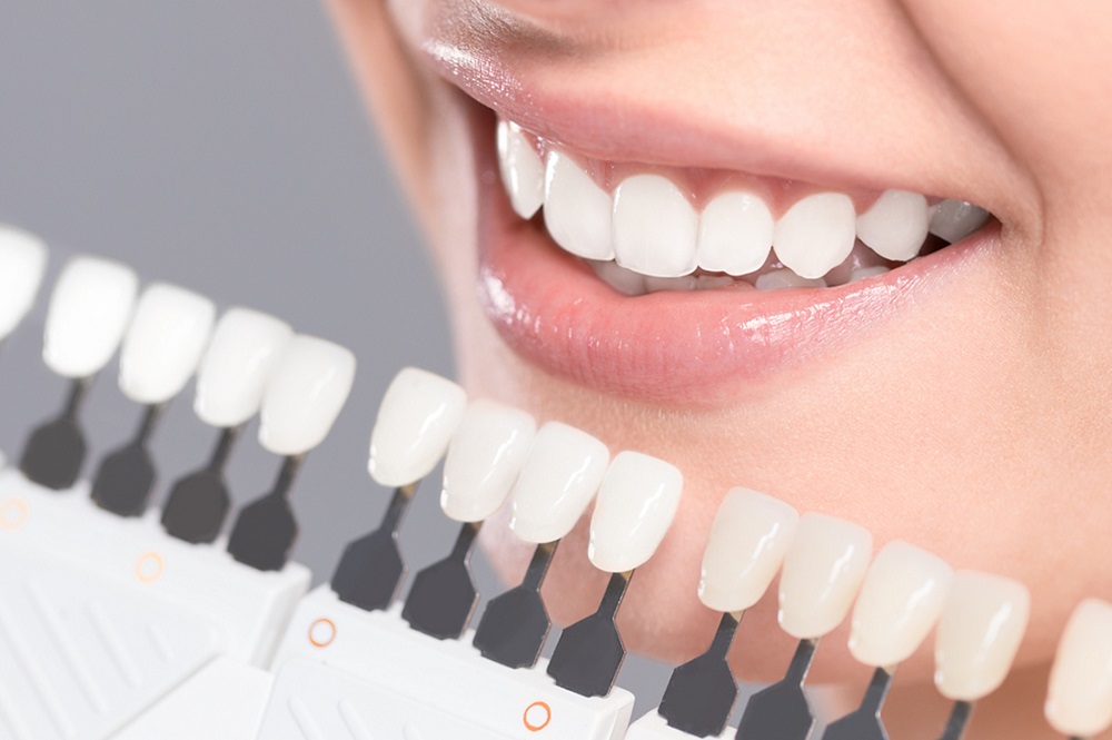 cost for porcelain veneers