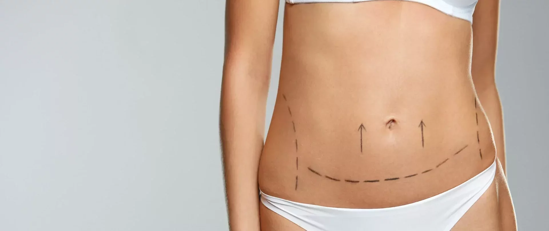  Liposuction