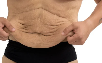 What to Do If You Have Loose Skin After Weight Loss