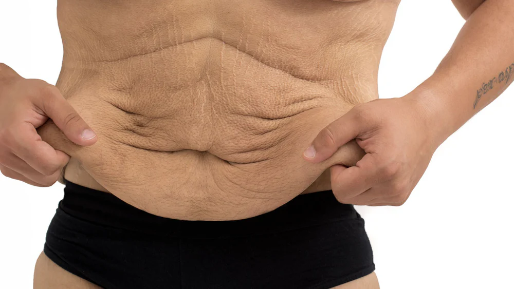 Loose Skin After Weight Loss