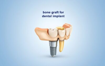 Bone Graft for Dental Implants: Everything You Need to Know