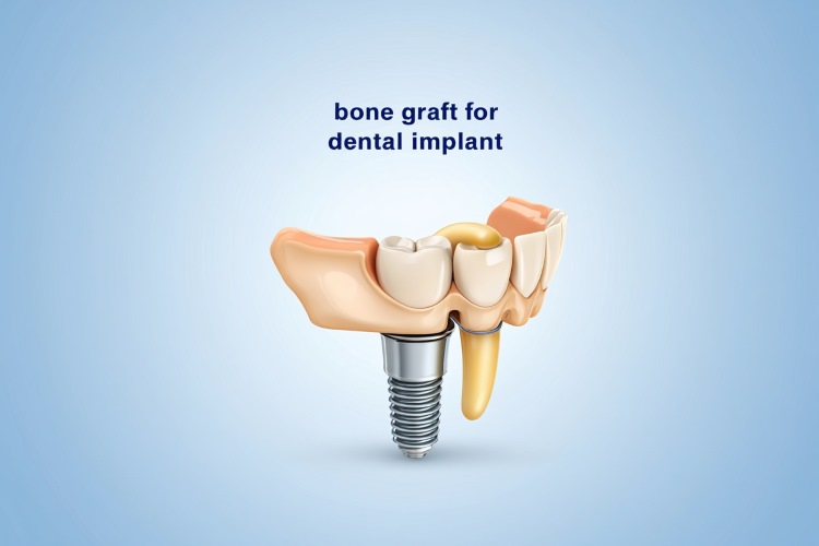 bone graft for dental implant​