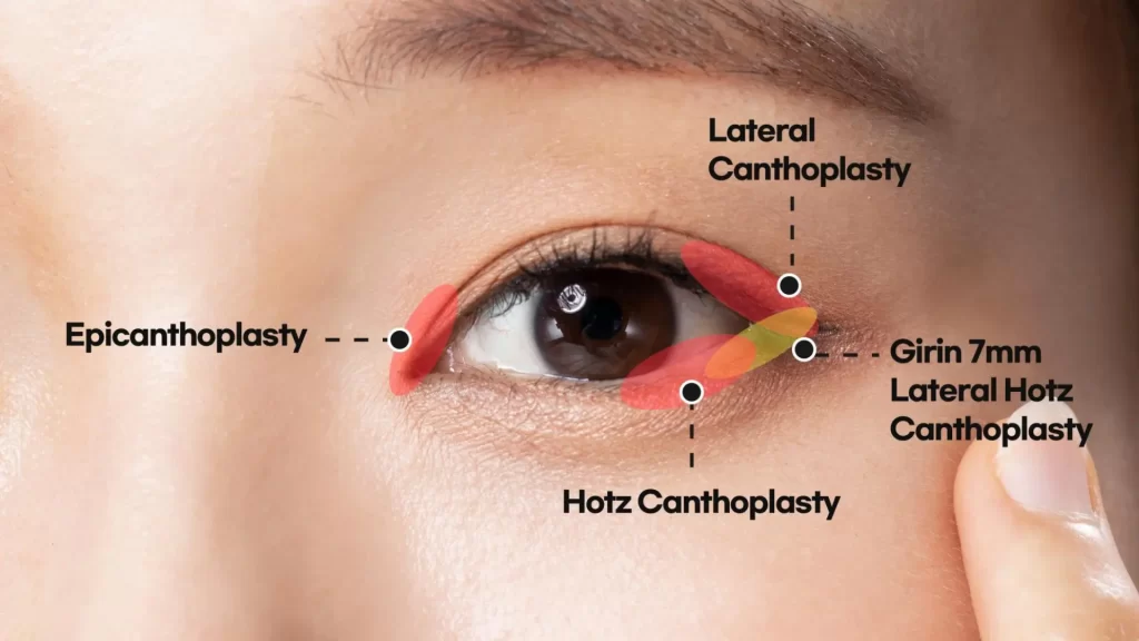 Canthoplasty surgery
