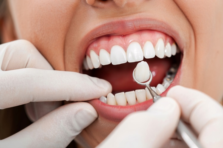 Front Dental Implants Guide