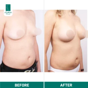 Breast Fat Transfer in Istanbul before & after
