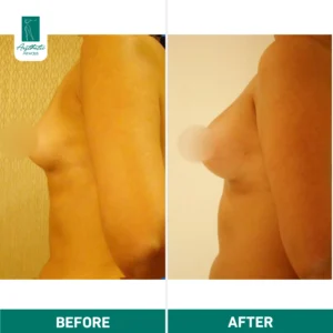 Breast Fat Transfer in Istanbul before & after