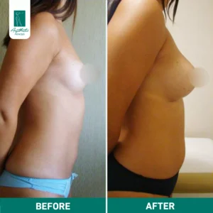 Breast Fat Transfer in Istanbul before & after
