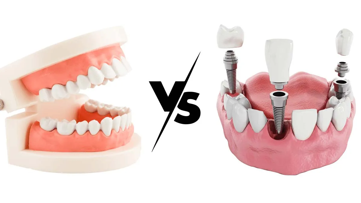 Dental Implants vs Dentures Cost