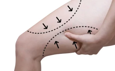 Medial vs Vertical Thigh Lift: Which Procedure Is Right for You?