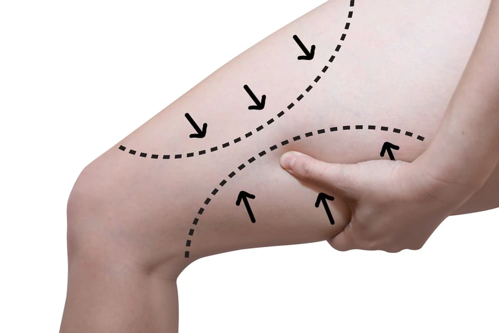 Medial vs Vertical Thigh Lift Which Procedure Is Right for You