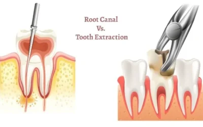 Root Canal vs Tooth Extraction: Which Option Is Right for You?