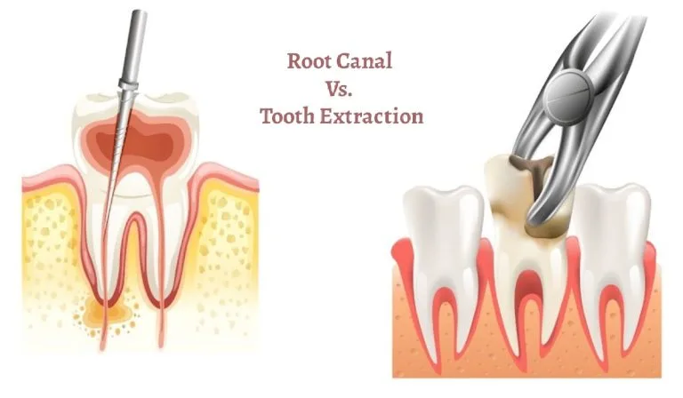 Root Canal vs Tooth Extraction Which Option Is Right for You