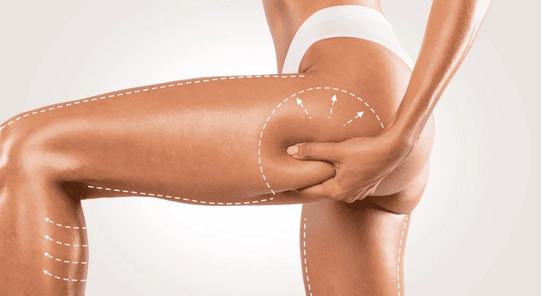 What Is a Medial Thigh Lift