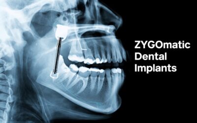 Zygomatic Dental Implants: The Ultimate Solution for Severe Bone Loss