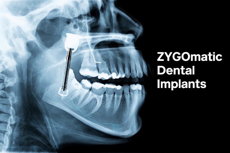 Zygomatic Dental Implants