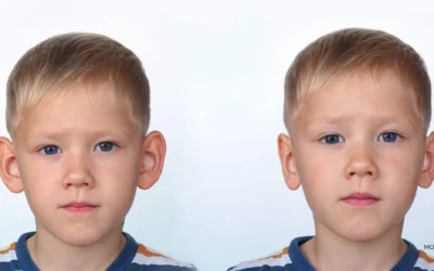 Otoplasty for Children in Turkey: Safe, Expert Care at Aesthetic Airways