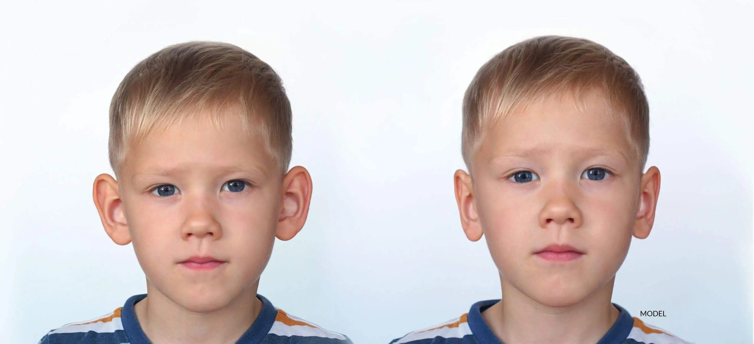 Otoplasty for Children