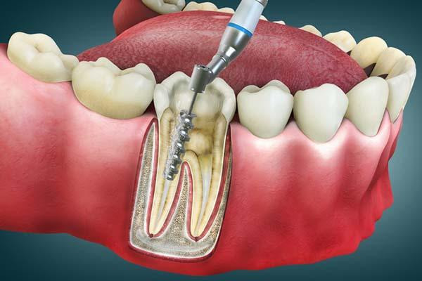 Benefits of Root Canal Treatment
