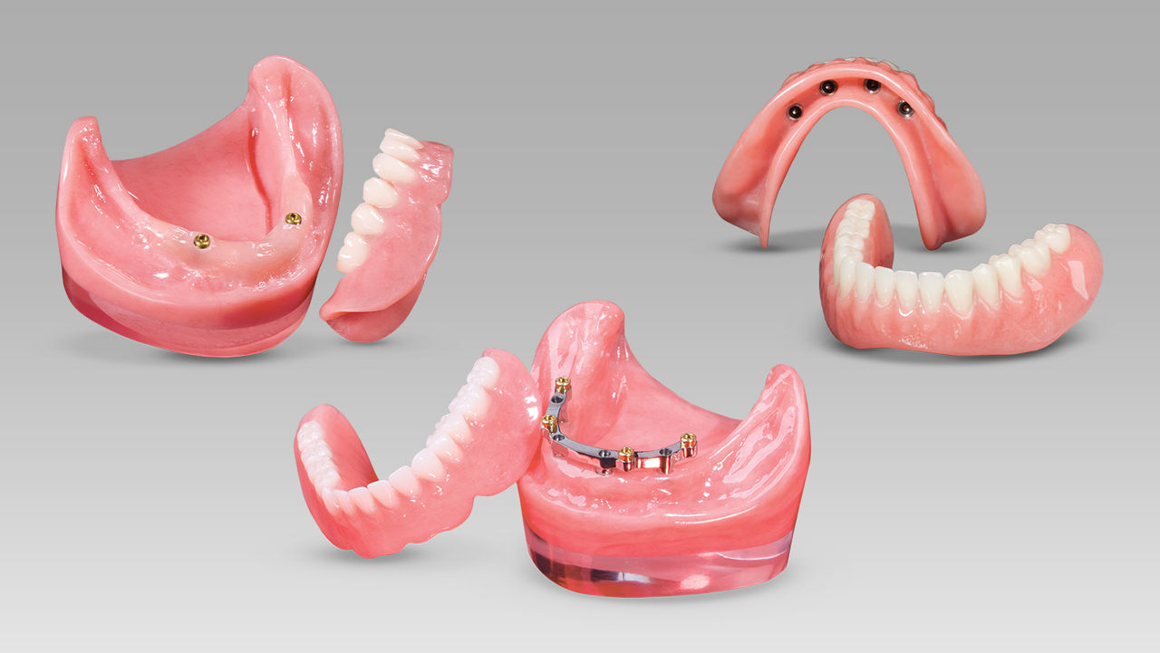 Types of Implant-Supported Dentures