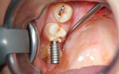 Everything You Need to Know About Mini Dental Implants
