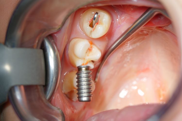 Everything You Need to Know About Mini Dental Implants