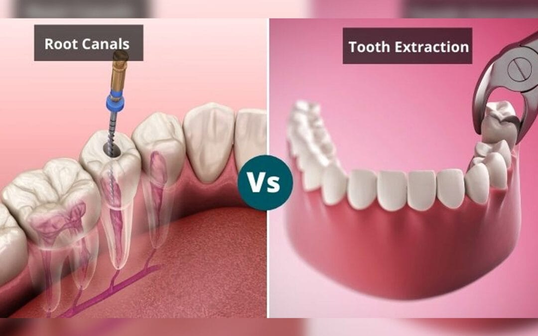 Root Canal vs Extraction: The Definitive Guide to Saving or Replacing Your Tooth