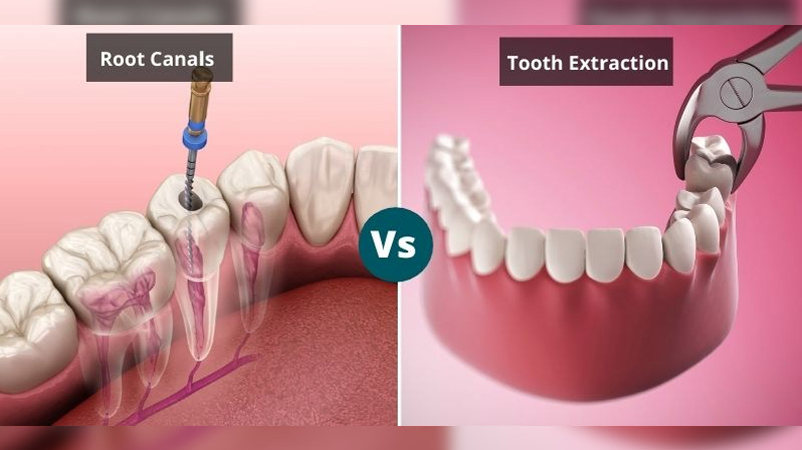 what-is-the-difference-between-root-canal-treatment-and-extraction Root Canal vs Extraction