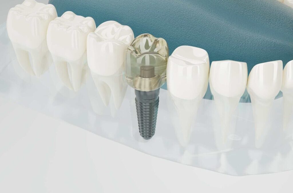 Navigating Your Options: A Guide to Types of Dental Implant Crowns