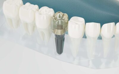 Navigating Your Options: A Guide to Types of Dental Implant Crowns