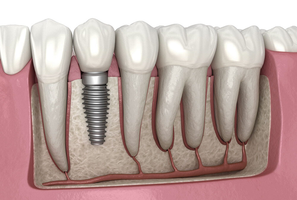 Everything You Need to Know About Molar Tooth Implant Surgery