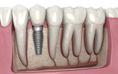 Everything You Need to Know About Molar Tooth Implant Surgery