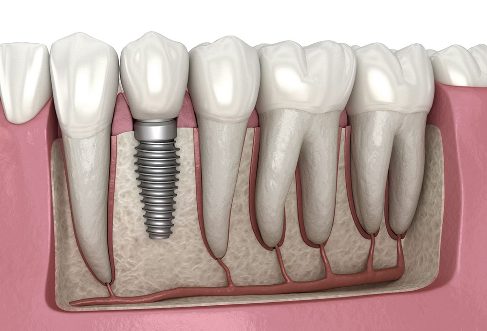 Molar Tooth Implant Surgery