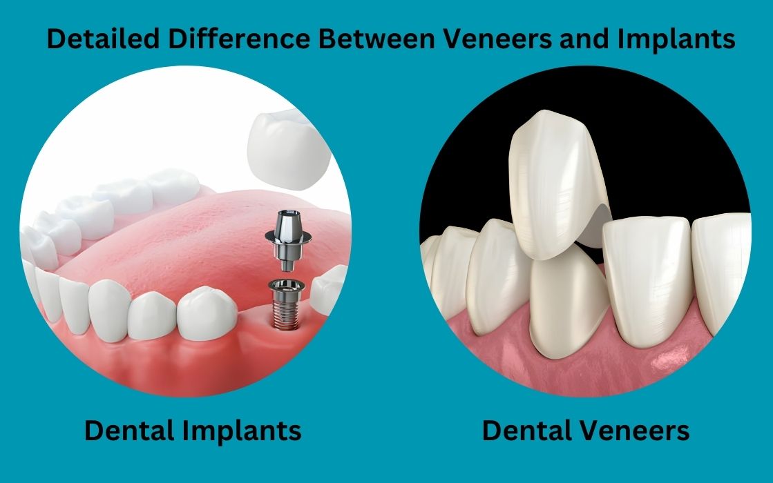Difference-Between-Veneers-and-Implants