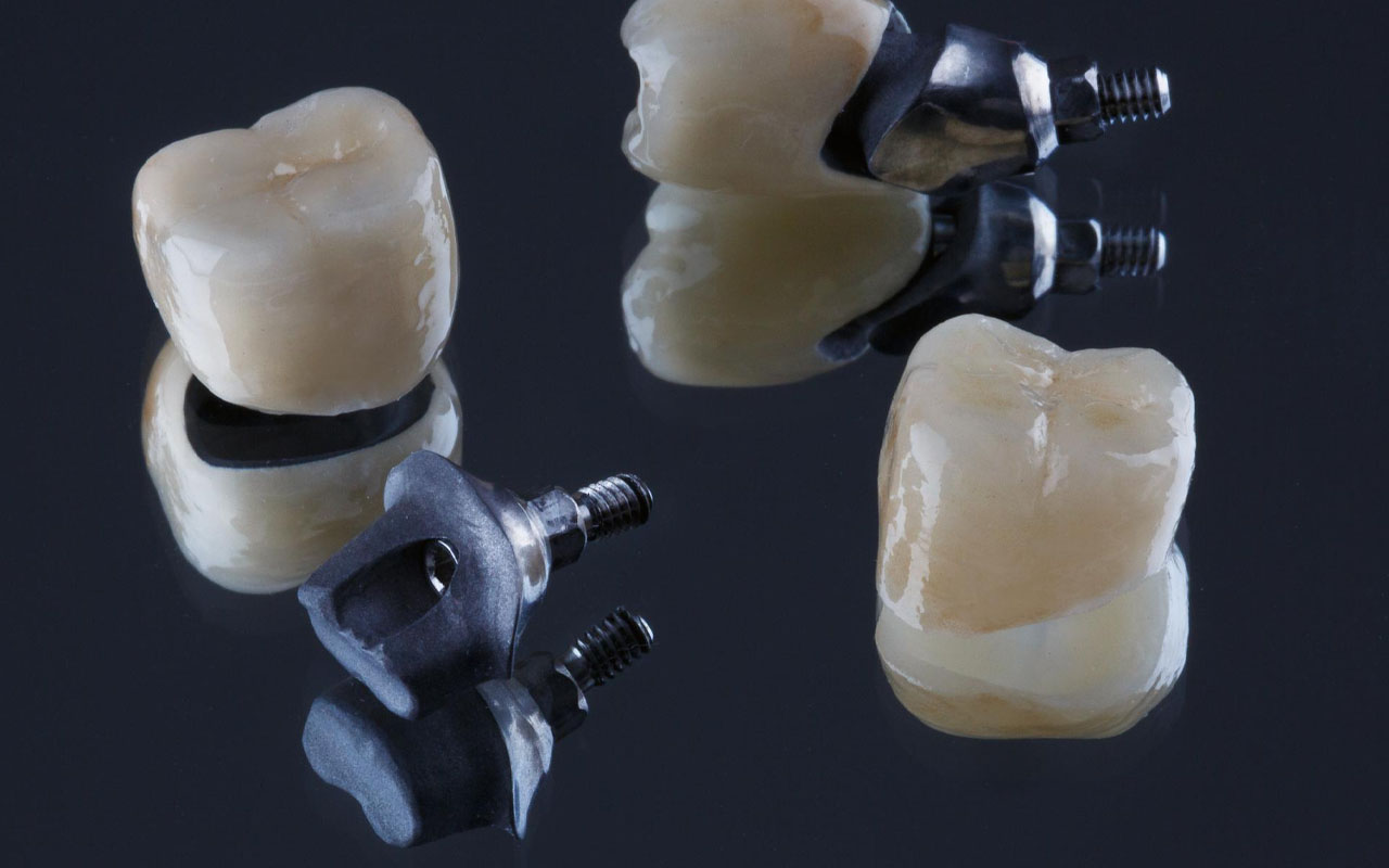 Types of Dental Implant Crowns