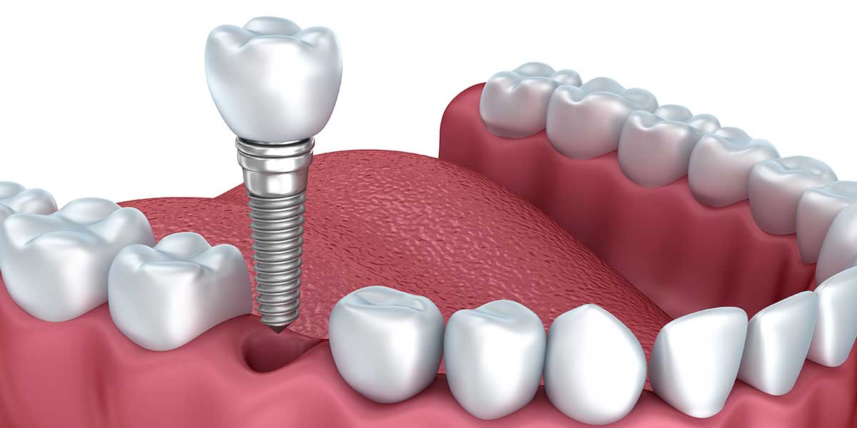 What are Dental Implants