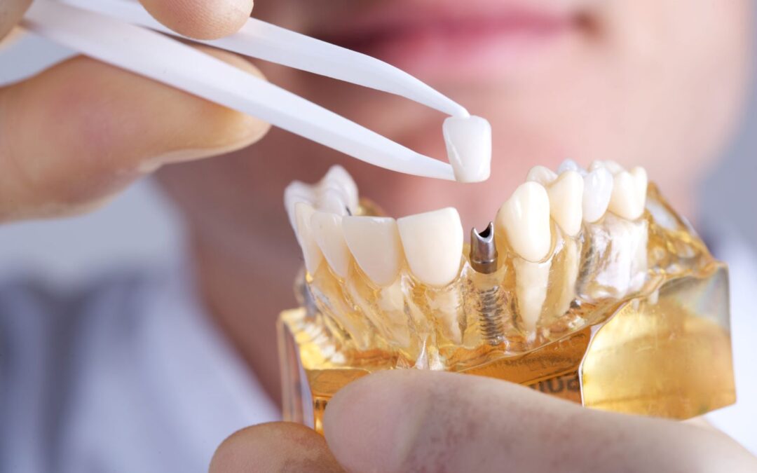 Dental Implant Crown in Turkey: Restore Your Smile with Confidence
