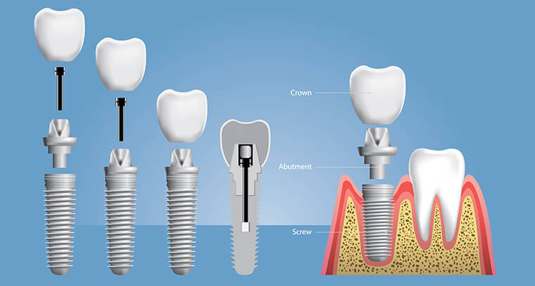 How dental implants Parts Work