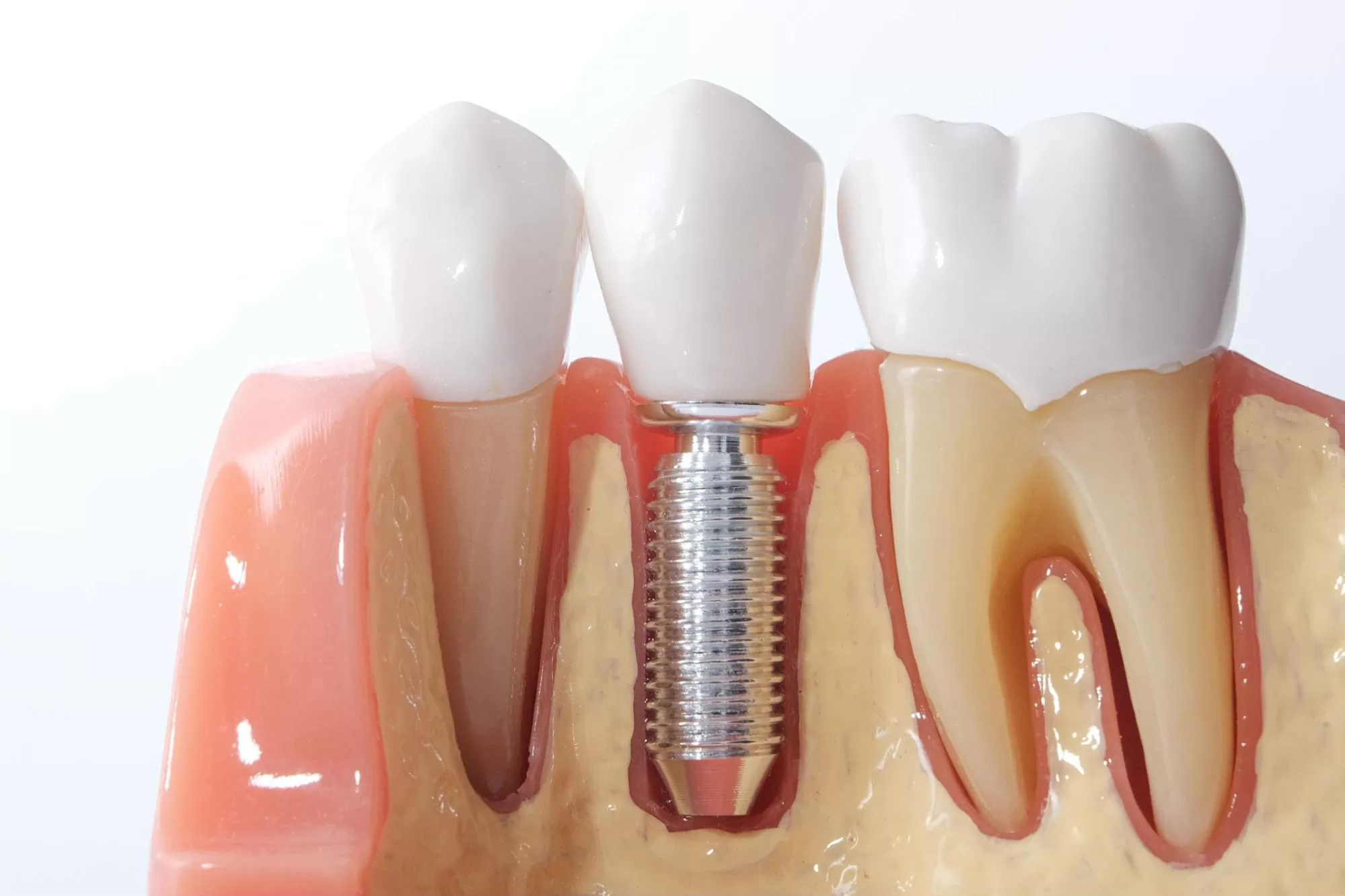 Benefits of a Dental Implant Crown